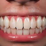 歯のセラミックの魅力：見た目と機能の両方を向上させる